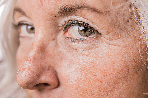 Las manchas en la piel por la edad tienen solución