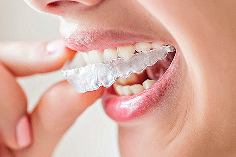 “La sonrisa que siempre has soñado: Descubre el poder de Invisalign y su ortodoncia invisible”