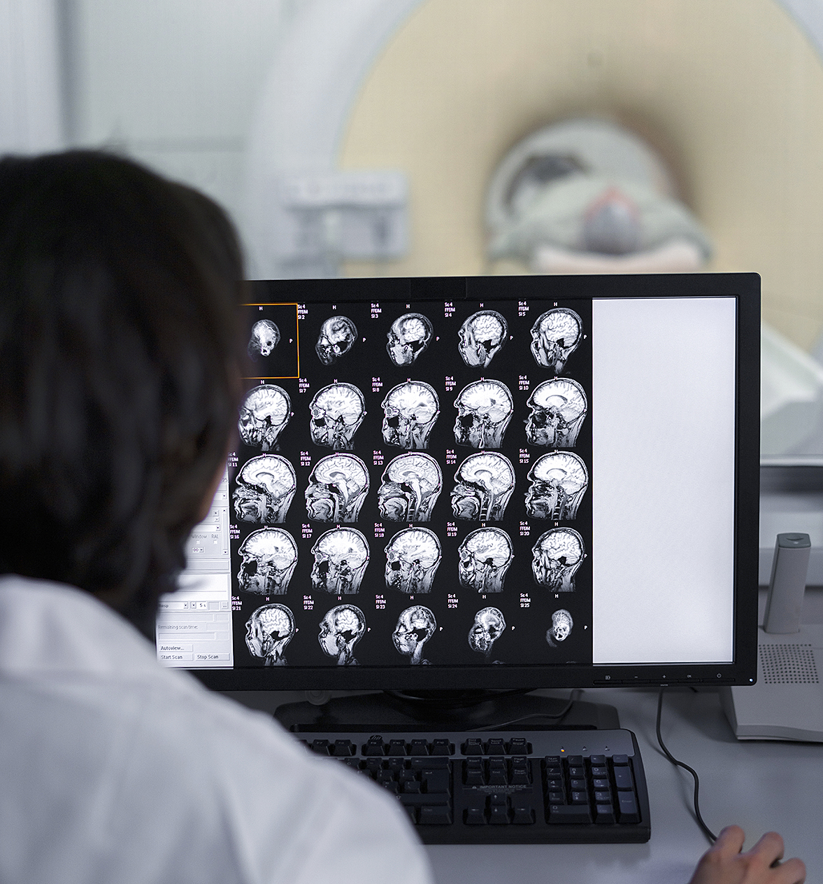 Prevención y alertas frente a un Accidente Cerebrovascular