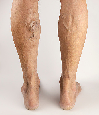 Varicose veins on men's legs. Treatment of varicose veins