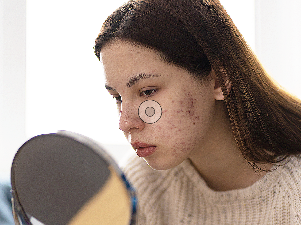 El acné no es “cosa de la edad”, ¡actúa!